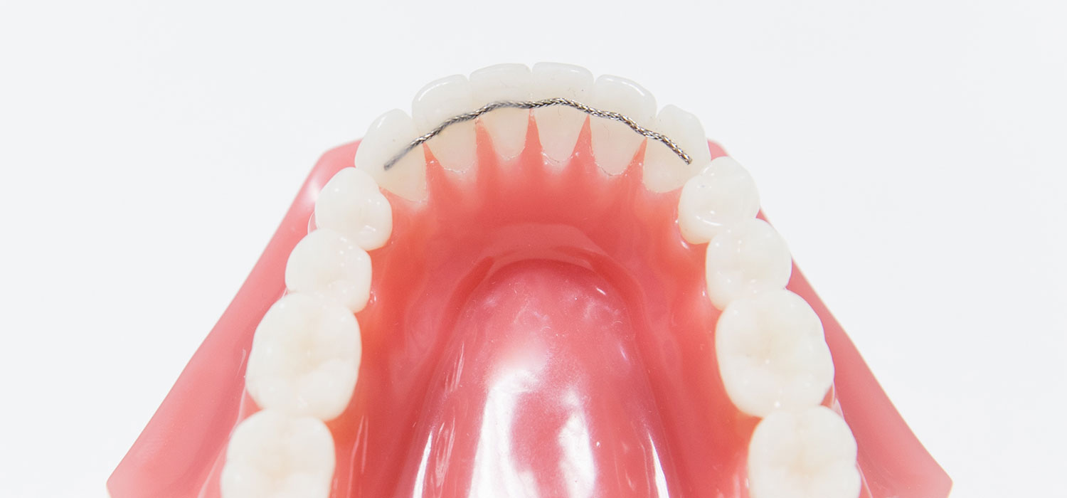 verschillende beugels retentiedraad of spalk orthodontiepraktijk leidsche rijn vleuten